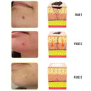 TAG RECEDE - Eliminador De Verrugas (Compra 1 y Lleva 2)