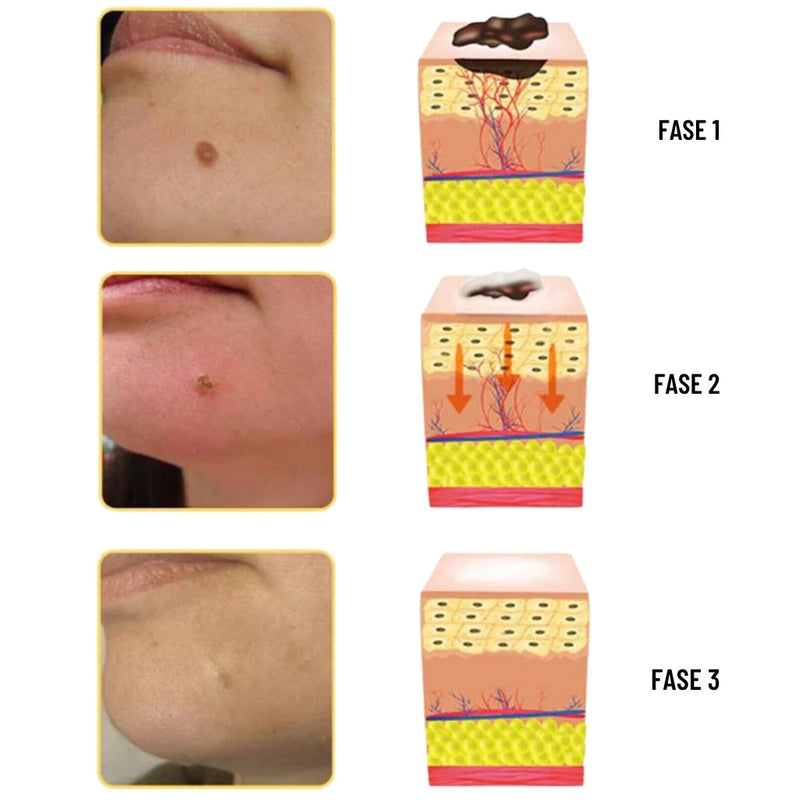 TAG RECEDE - Eliminador De Verrugas (Compra 1 y Lleva 2)